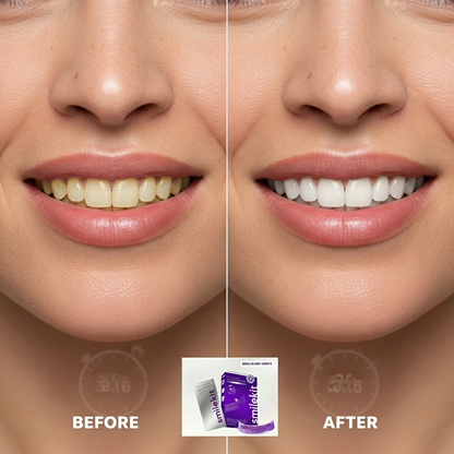 Bandes Blanchissantes Smilekit™ - Sourire blanc en 7 jours